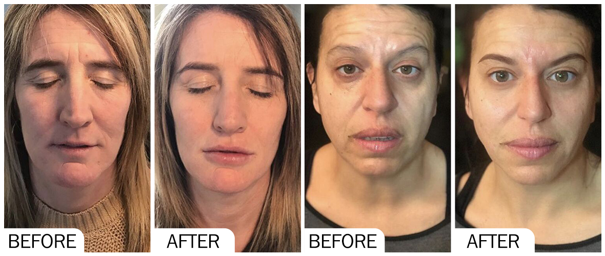 Before and After Facial Filler AOMA Antes y Después del Relleno Facial AOMA