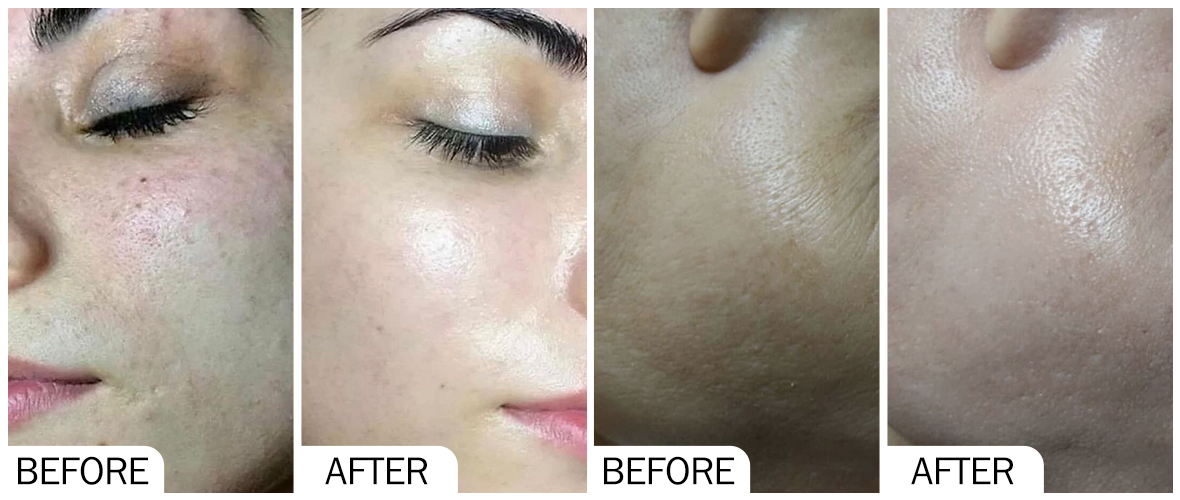 Before and After Skin Whitening AOMA Before and After Skin Whitening AOMA