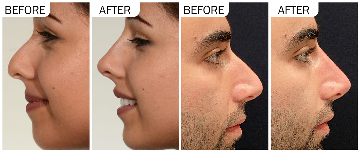 nose filler nose filler