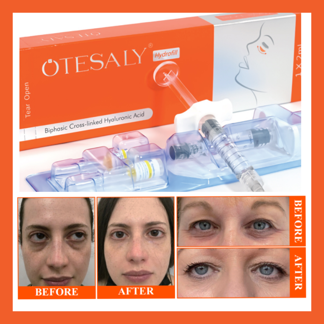 Antes y despu&eacute;s de Hydrofill.png