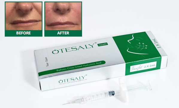 Los mejores rellenos para las l&iacute;neas de sonrisa