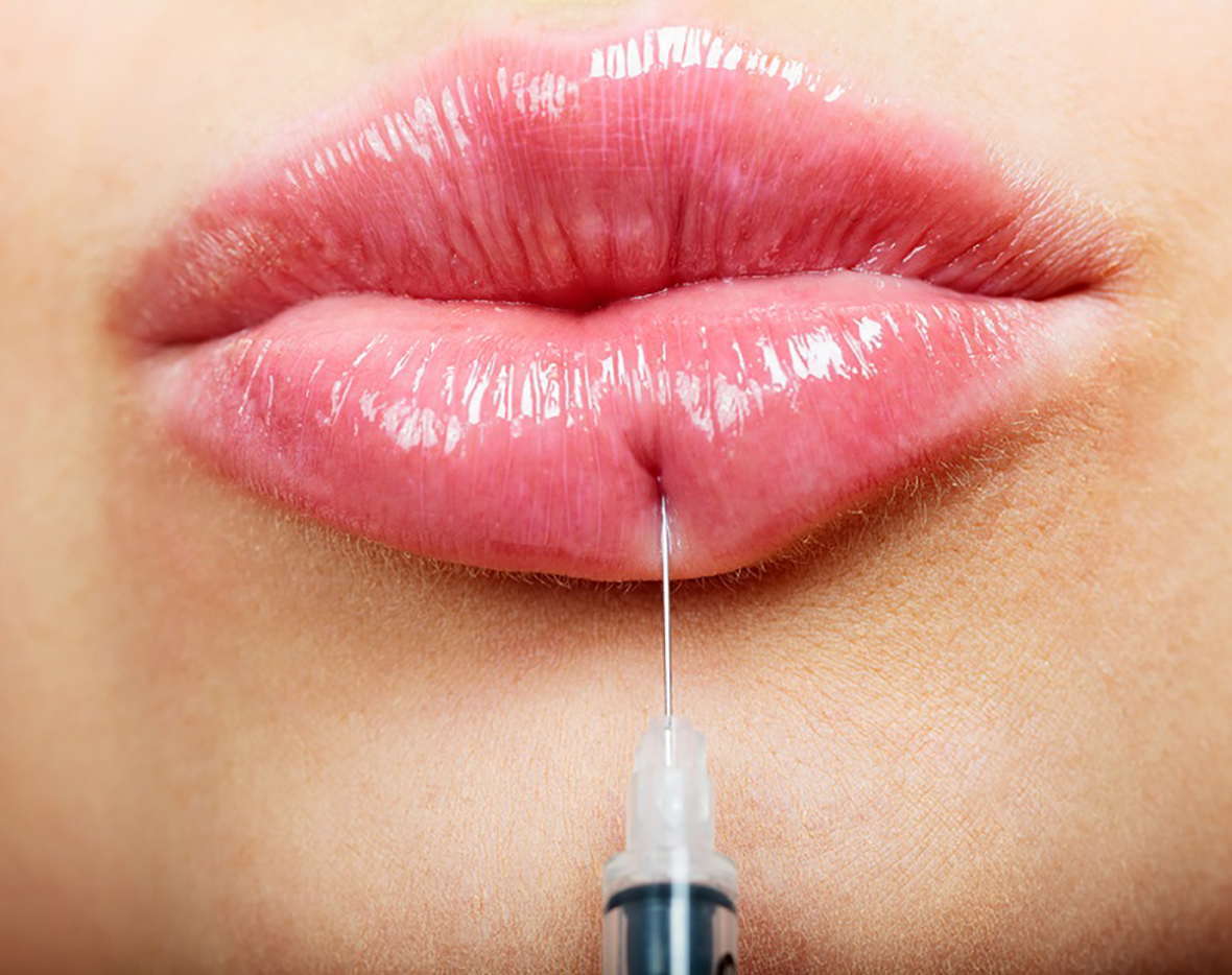 Lograr el puchero perfecto: explorar los beneficios de las inyecciones para rellenar los labios