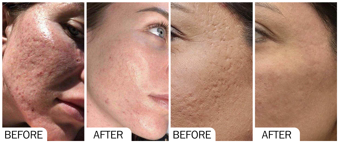 Antes y despu&eacute;s del rejuvenecimiento de la piel AOMA