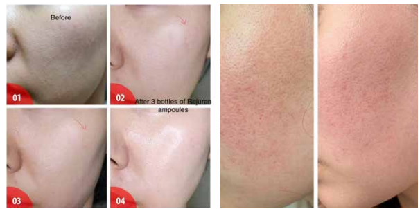 Fotos de antes y despu&eacute;s de AOMA PDRN