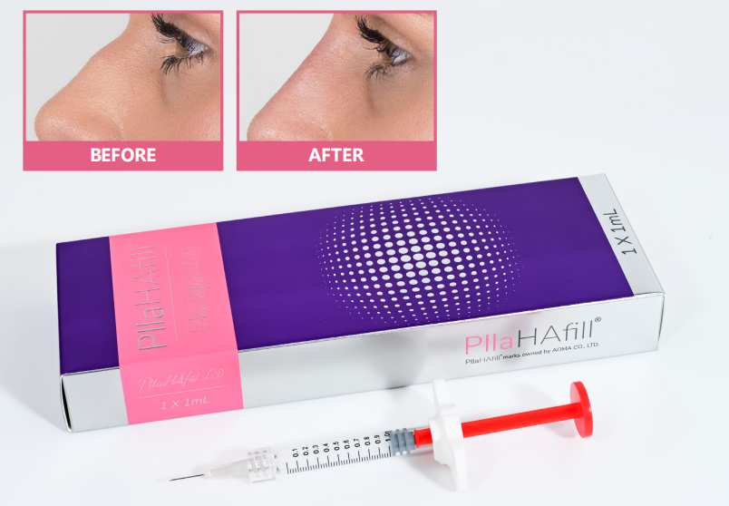 Inyecci&oacute;n de col&aacute;geno PLLA