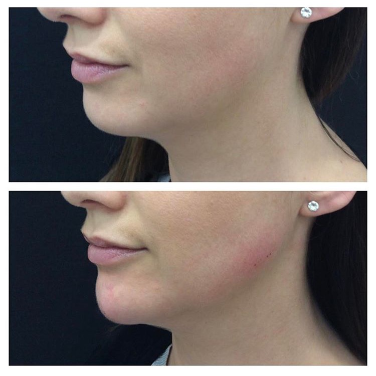 Imagen de antes y despu&eacute;s de AOMA Chin Filler