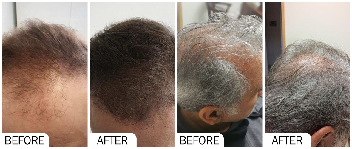 Antes y Despu&eacute;s Antica&iacute;da AOMA