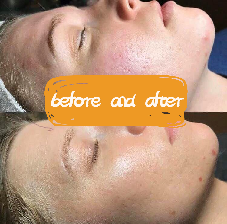 Rejuvenecimiento de la piel AOMA antes y despu&eacute;s