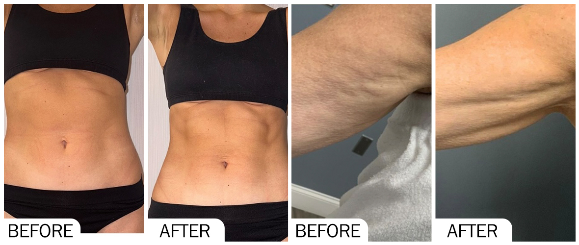 Im&aacute;genes de antes y despu&eacute;s de la soluci&oacute;n AOMA Fat-X