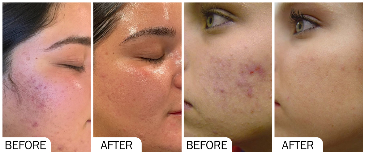 AOMA antes y despu&eacute;s del rejuvenecimiento de la piel