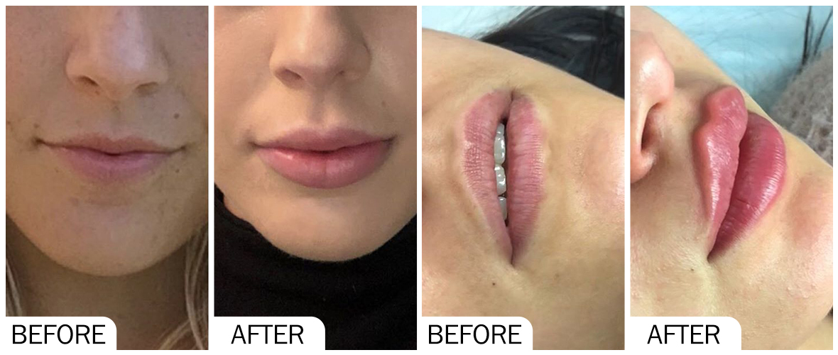 Antes y despu&eacute;s del relleno de labios AOMA