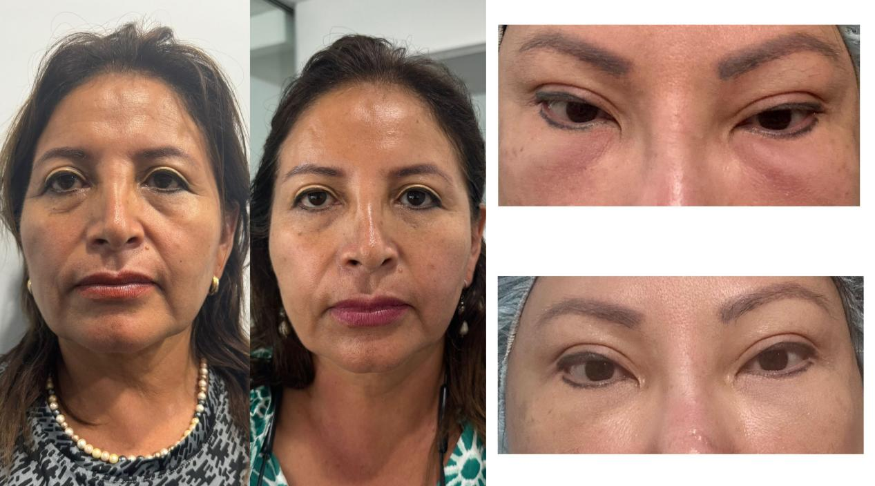 inyecci&oacute;n de &aacute;cido hialur&oacute;nico antes y despu&eacute;s