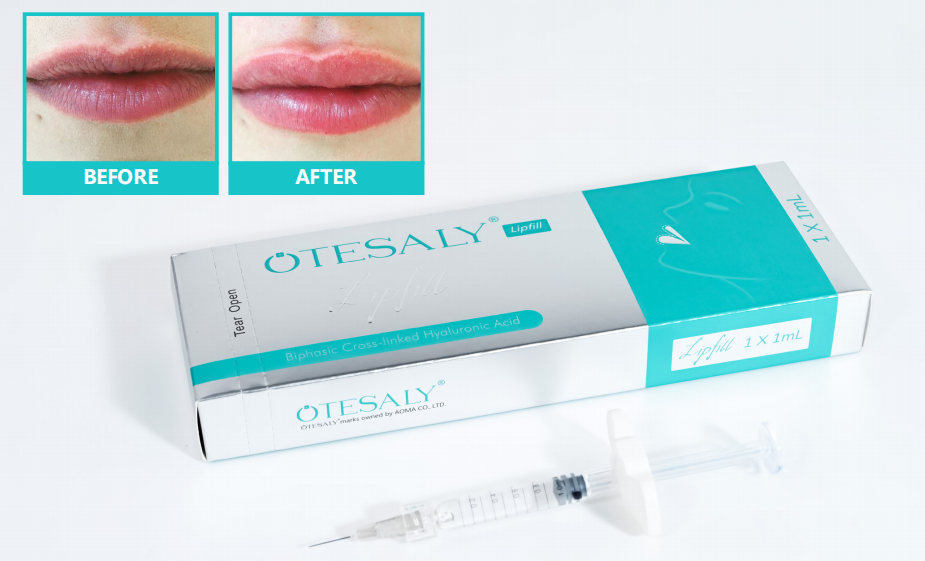 AOMA Relleno de labios 1ml