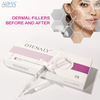 Aumento de mejillas y mentón con relleno facial Facefill 2ML aprobado por la CE