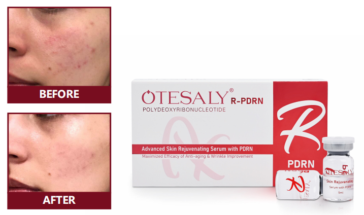 R-PDRN Mesoterapia AOMA