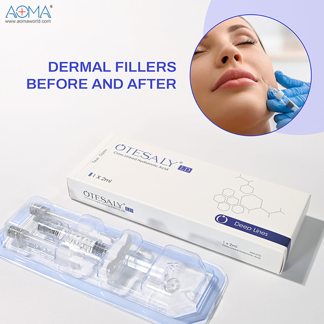 Líneas glabelares bifásicas del ceño del llenador facial de lidocaína 2ml