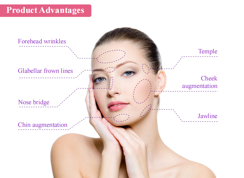 Diagrama de visualizaci&oacute;n del &aacute;rea de rellenos de &aacute;cido hialur&oacute;nico