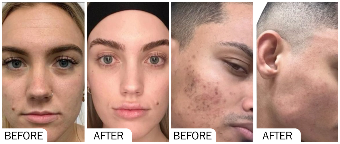 Fotos de antes y despu&eacute;s de AOMA R-PDRN