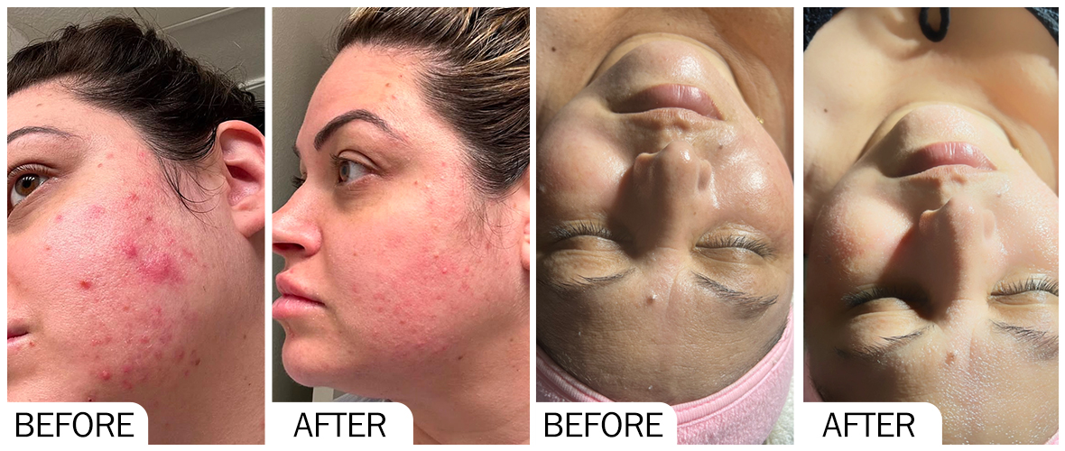 Antes y despu&eacute;s de SKINBOOSTER AOMA