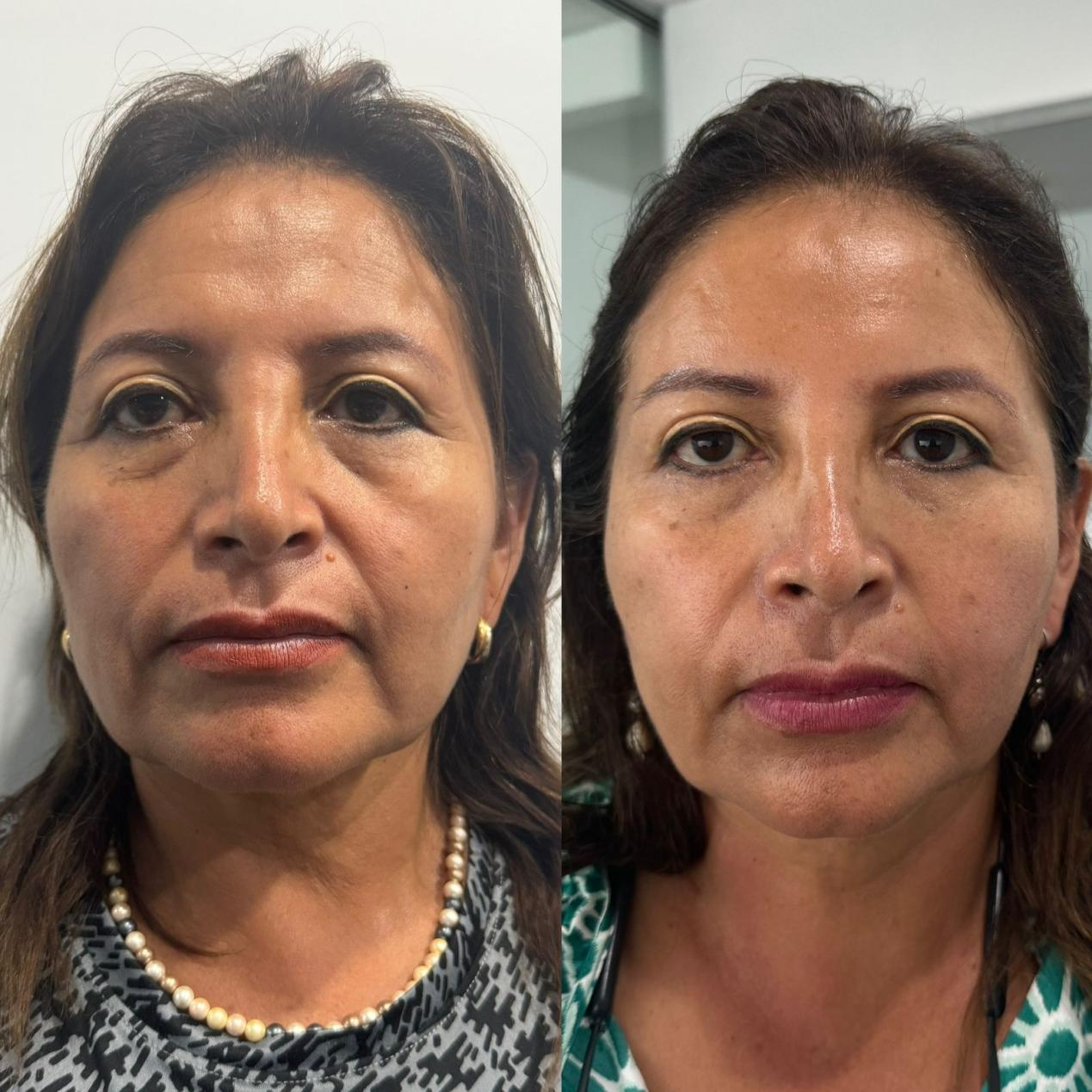 Relleno antiarrugas AOMA Facefill