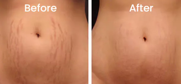 Inyecci&oacute;n para perder peso que disuelve grasa antes y despu&eacute;s