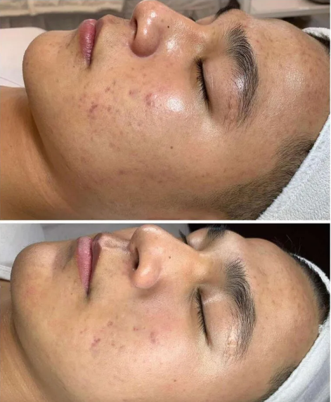 AOMA Mesoterapia rejuvenecimiento facial antes despu&eacute;s