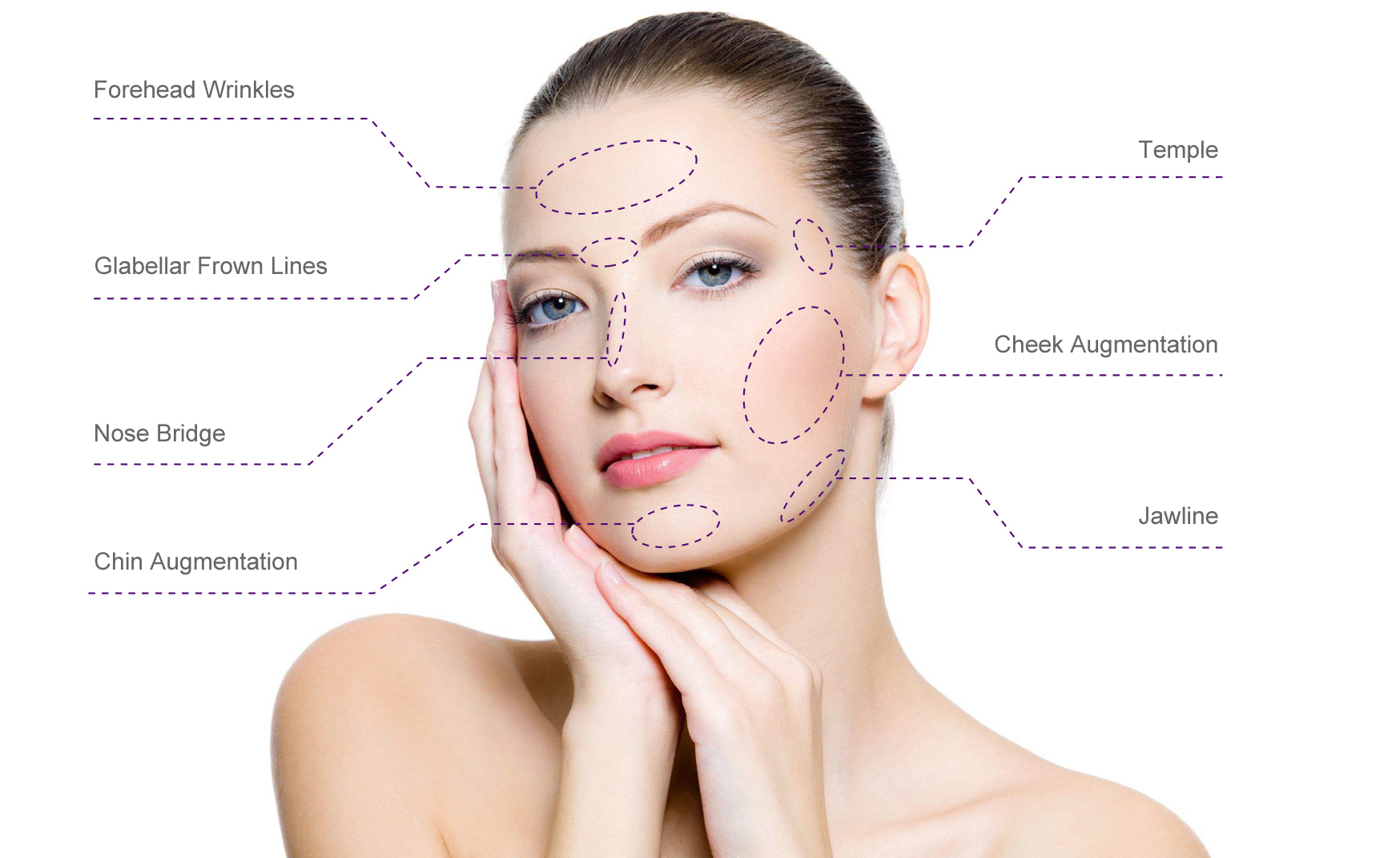 Lograr un aumento de mejillas de apariencia natural con rellenos dérmicos de ácido hialurónico