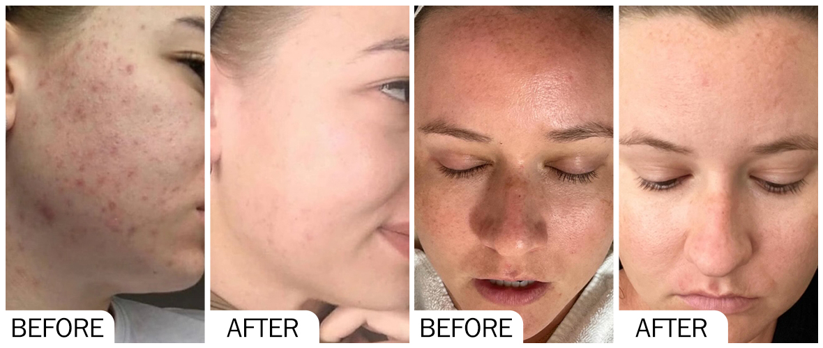 AOMA antes y despu&eacute;s del blanqueamiento de la piel