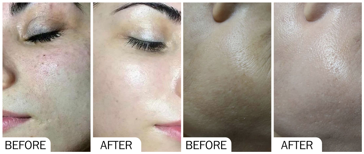 Antes y despu&eacute;s del blanqueamiento de la piel AOMA