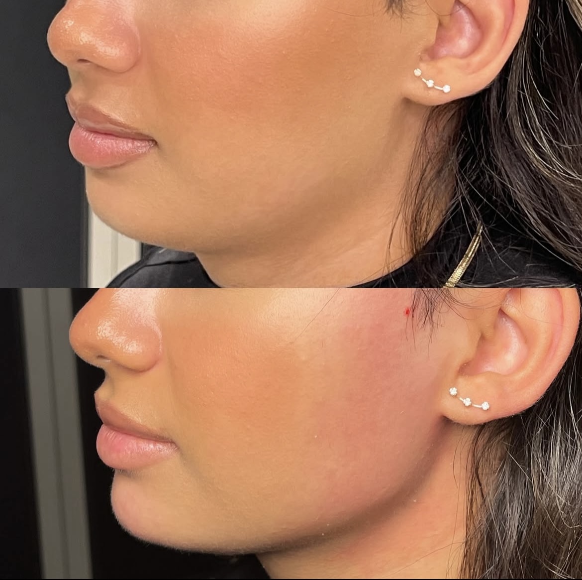 AOMA Antes y Despu&eacute;s de Cahafill 2ml