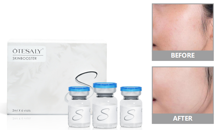 inyecci&oacute;n de refuerzo de la piel