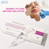 Cirugía Estética LÍNEAS PROFUNDAS 2ML Relleno Facial Base Nasal Levantamiento de Nariz