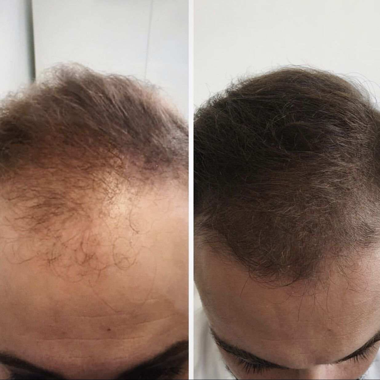 mesoterapia capilar antes y despu&eacute;s