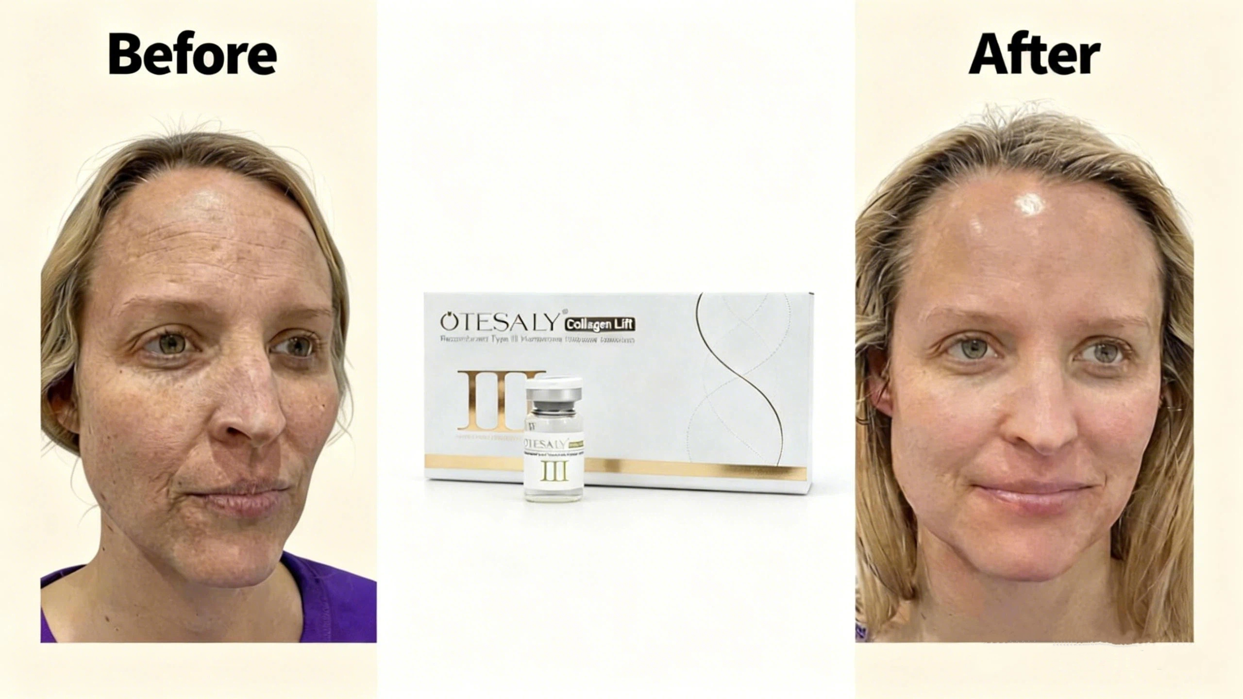 Cuadro comparativo de mesoterapia con lifting de col&aacute;geno AOMA