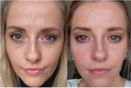 Antes y despu&eacute;s de las inyecciones de mesoterapia Sculptra