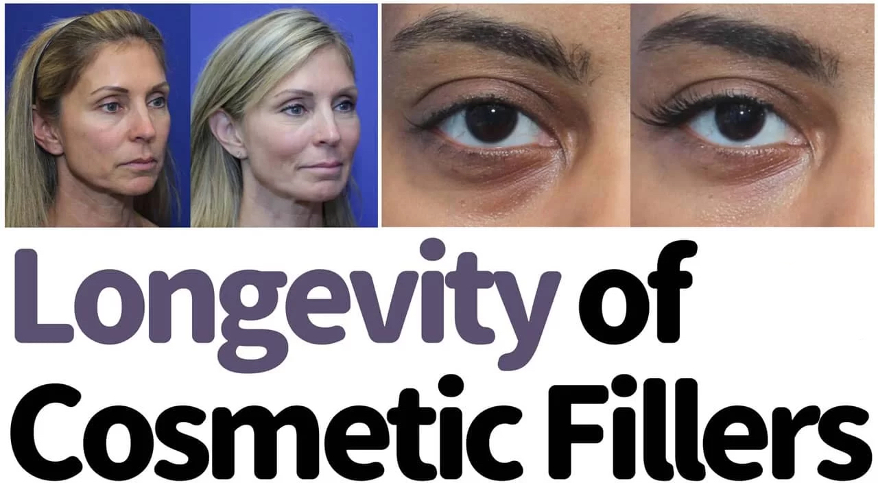 longevidad de los rellenos cosm&eacute;ticos