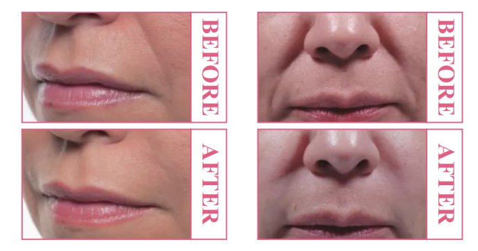 Rejuvenecimiento facial de apariencia natural