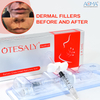 Reducción cutánea de las arrugas del llenador de lidocaína de Medical Spa 1ml