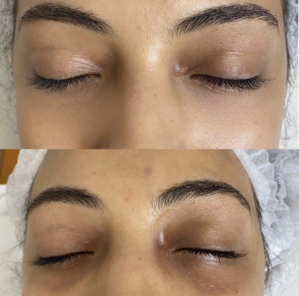 despu&eacute;s antes Inyecciones de mesoterapia con elevaci&oacute;n de col&aacute;geno