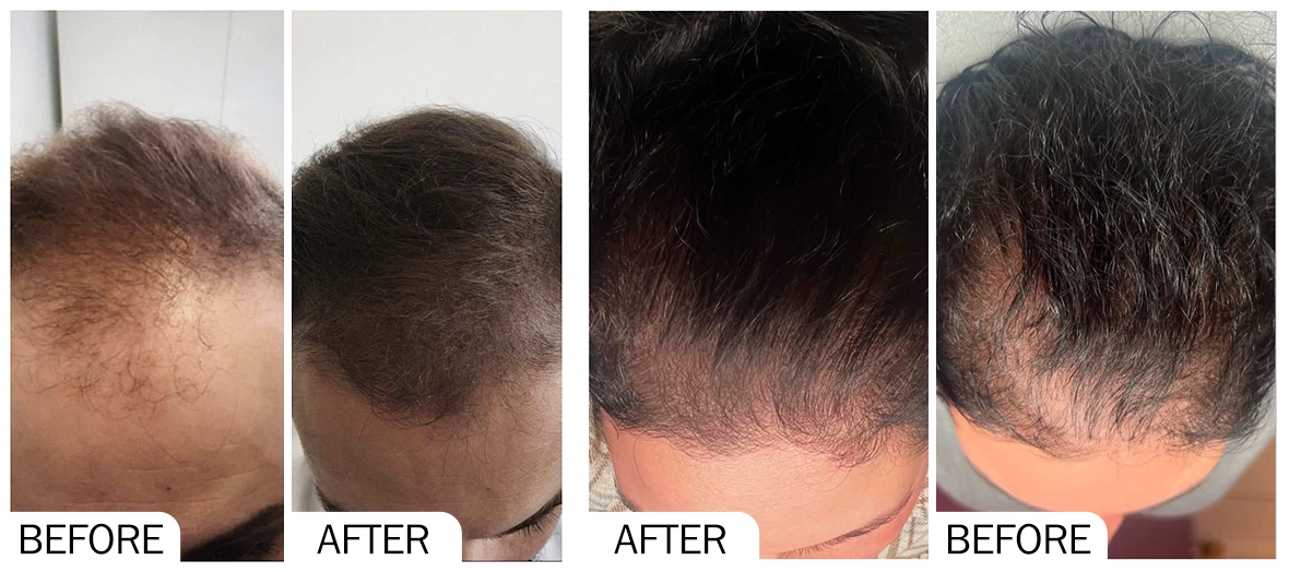 Mesoterapia para el crecimiento del cabello antes y despu&eacute;s.