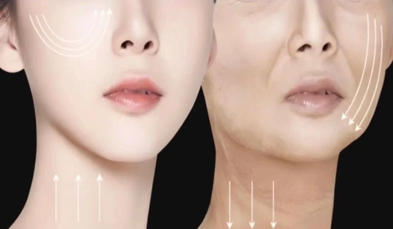 Restauración del contorno de la parte media de la cara: un estudio de caso clínico sobre la corrección del aumento de mejillas con rellenos de HA