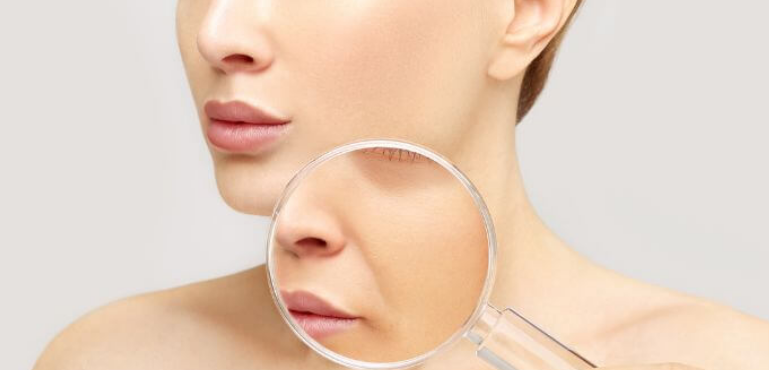 l&iacute;neas de sonrisa o pliegues nasolabiales