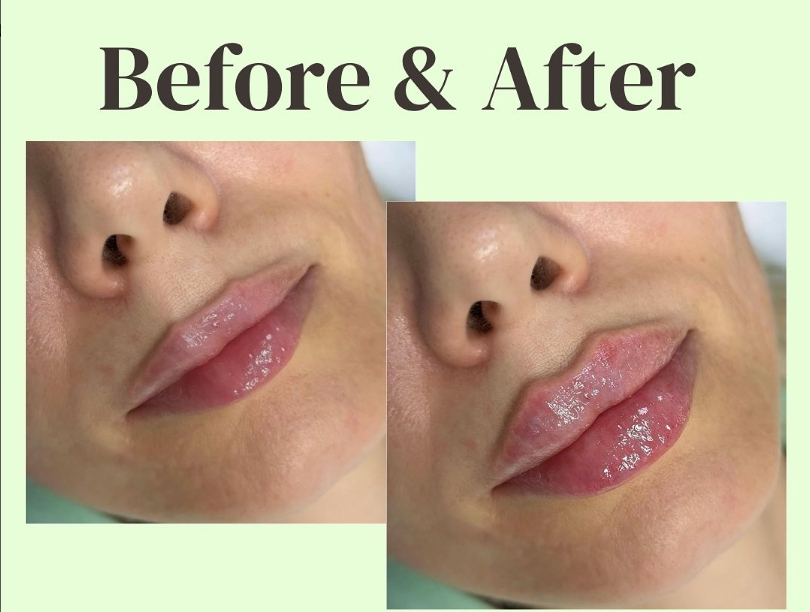 Resultados de los rellenos de labios