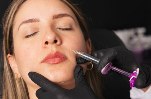 Inyecci&oacute;n de &aacute;cido hialur&oacute;nico para pliegues nasolabiales