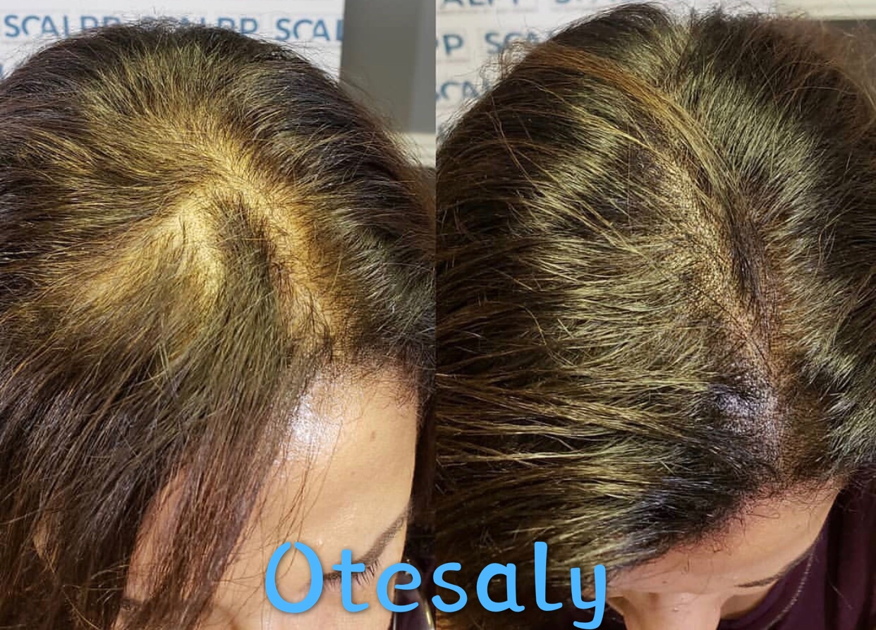Anti-Hair Loss Mesotherapy Case Results AOMA.png
