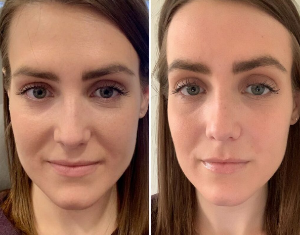 Inyecci&oacute;n de &aacute;cido hialur&oacute;nico para pliegues nasolabiales antes y despu&eacute;s